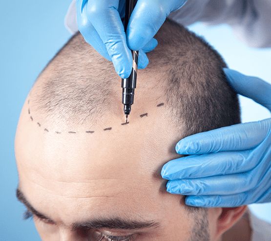 Hair Restoration in Delhi
